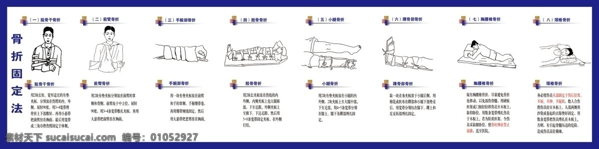 骨折固定法 驾校展板 鼠绘图片 手臂骨折 股骨骨折 分层