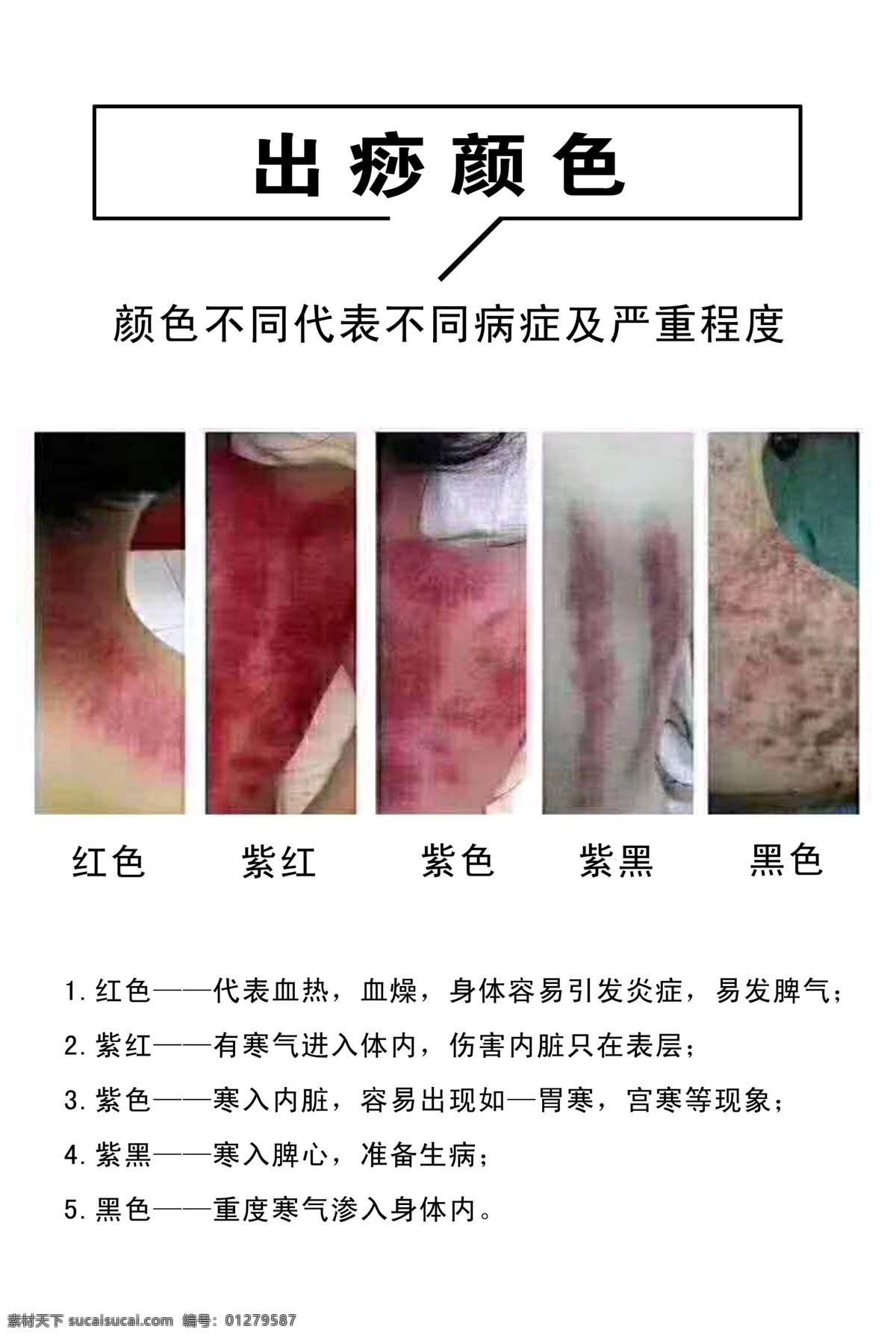 出痧颜色 海报 清晰 出痧病症 不同颜色 分层