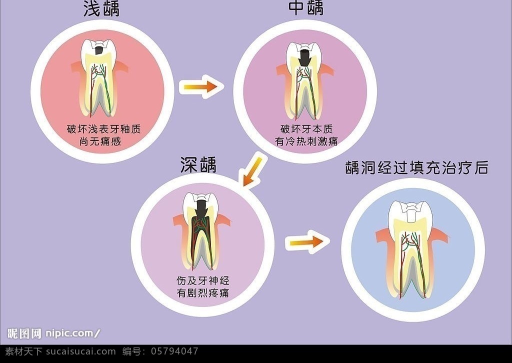 龋齿形成图解 龋齿 生活百科 医疗保健 矢量图库