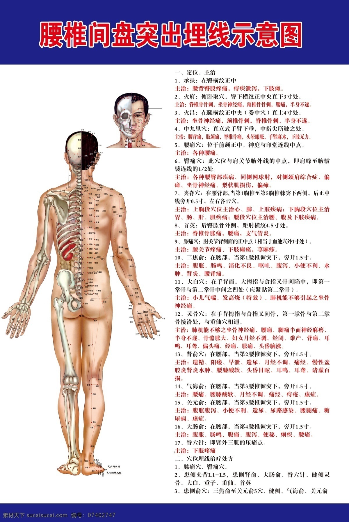 腰椎间盘 突出 埋线 示意图 腰椎间盘突出 海报 人体 分层