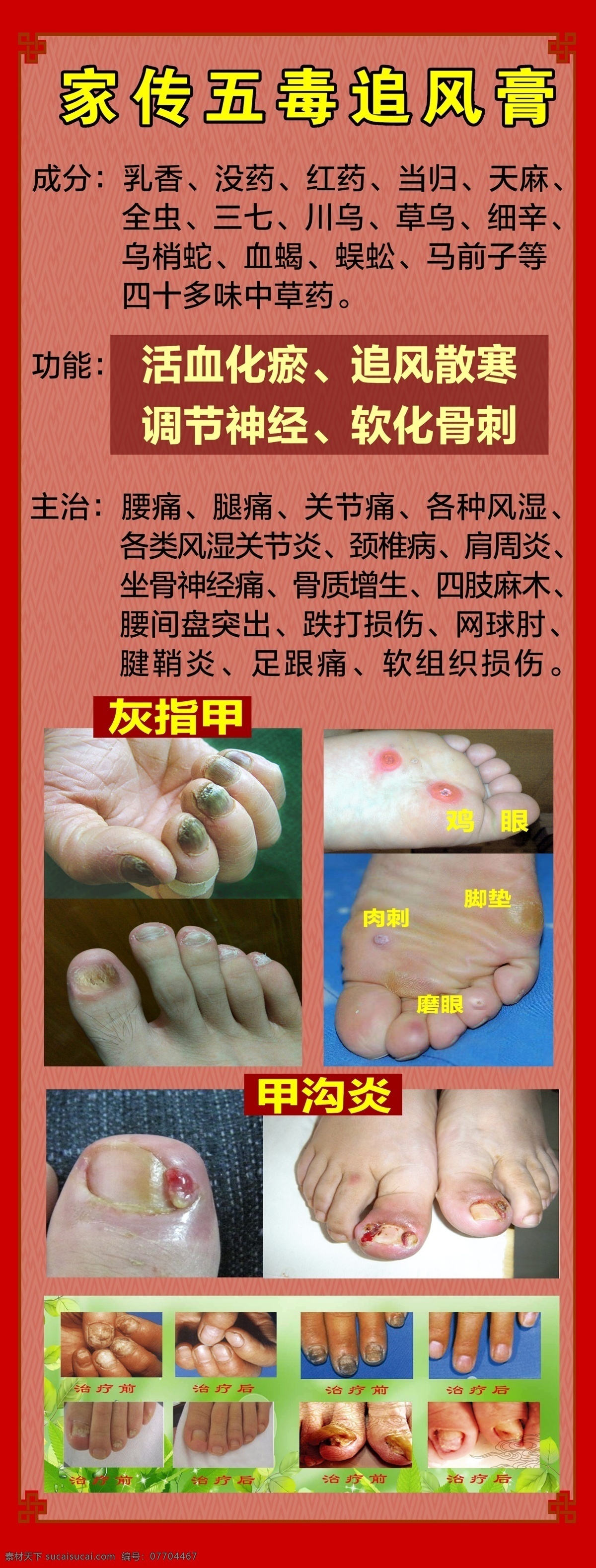 灰指甲治疗 灰指甲 治疗灰指甲 展架 灰指甲图片 甲沟炎 脚 鸡眼 展板模板