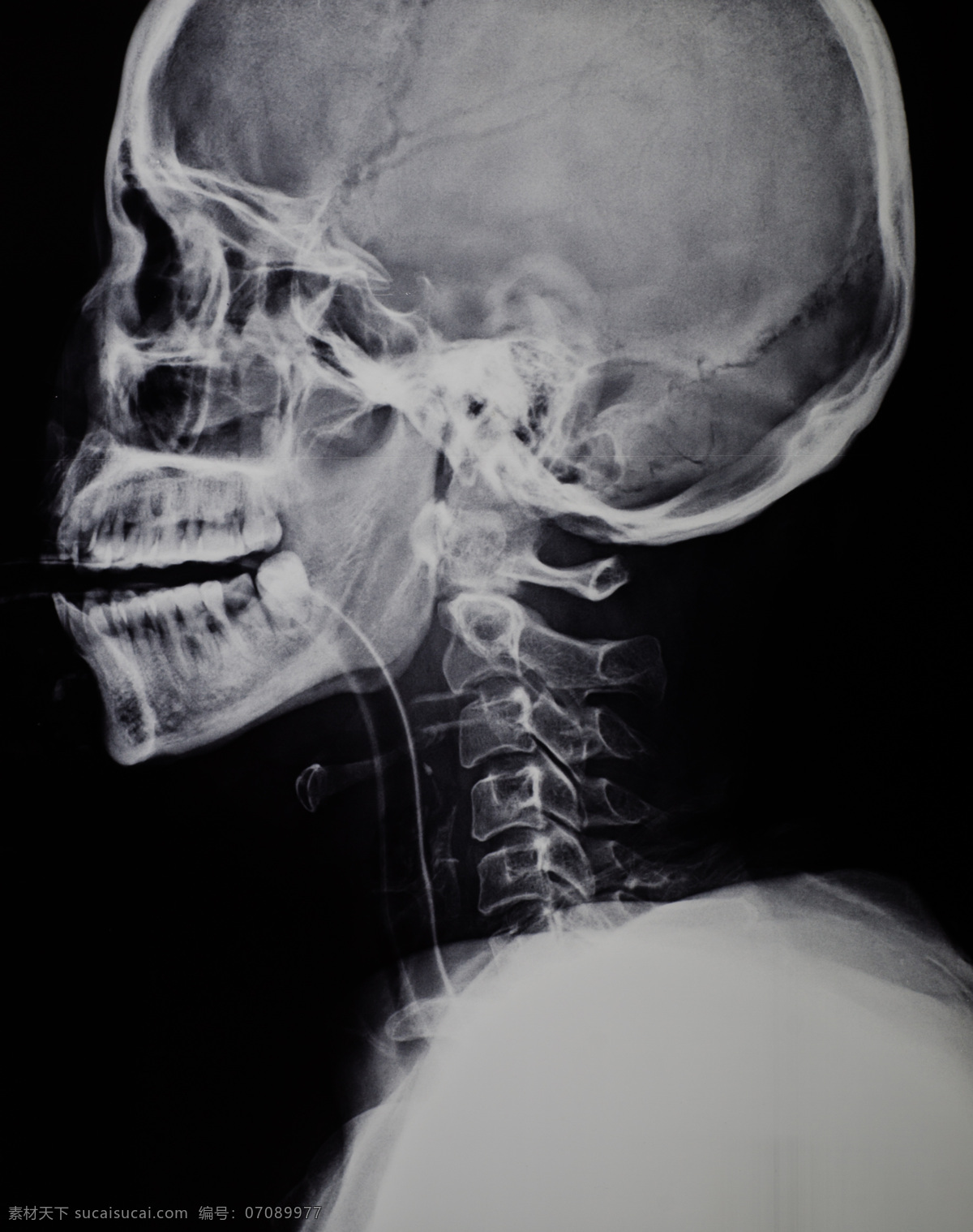 脖子 x 光 片 医疗护理 医学研究 x光片 x光片图片 医疗 拍片 医学研究素材 护理 图片库 现代科技