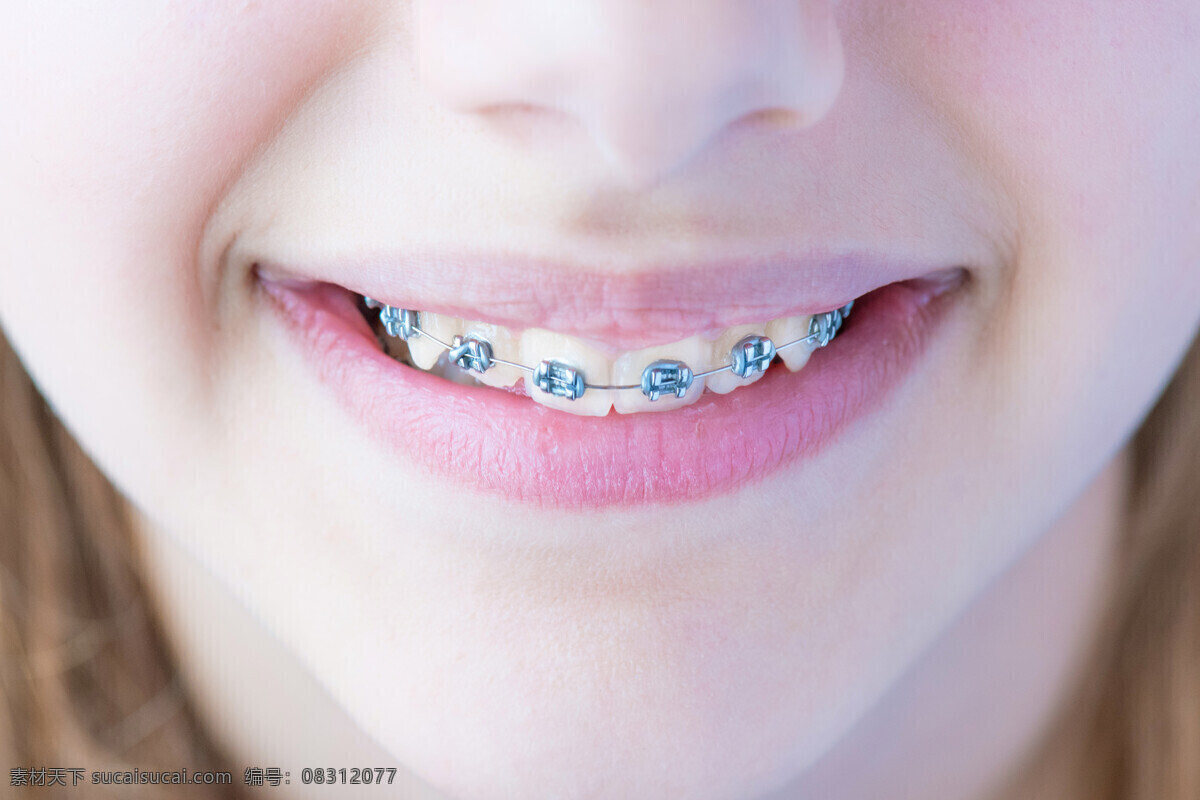 牙齿矫正 牙齿 牙箍 牙套 牙线 洁白牙齿 口腔护理 牙科 牙模型 生活百科