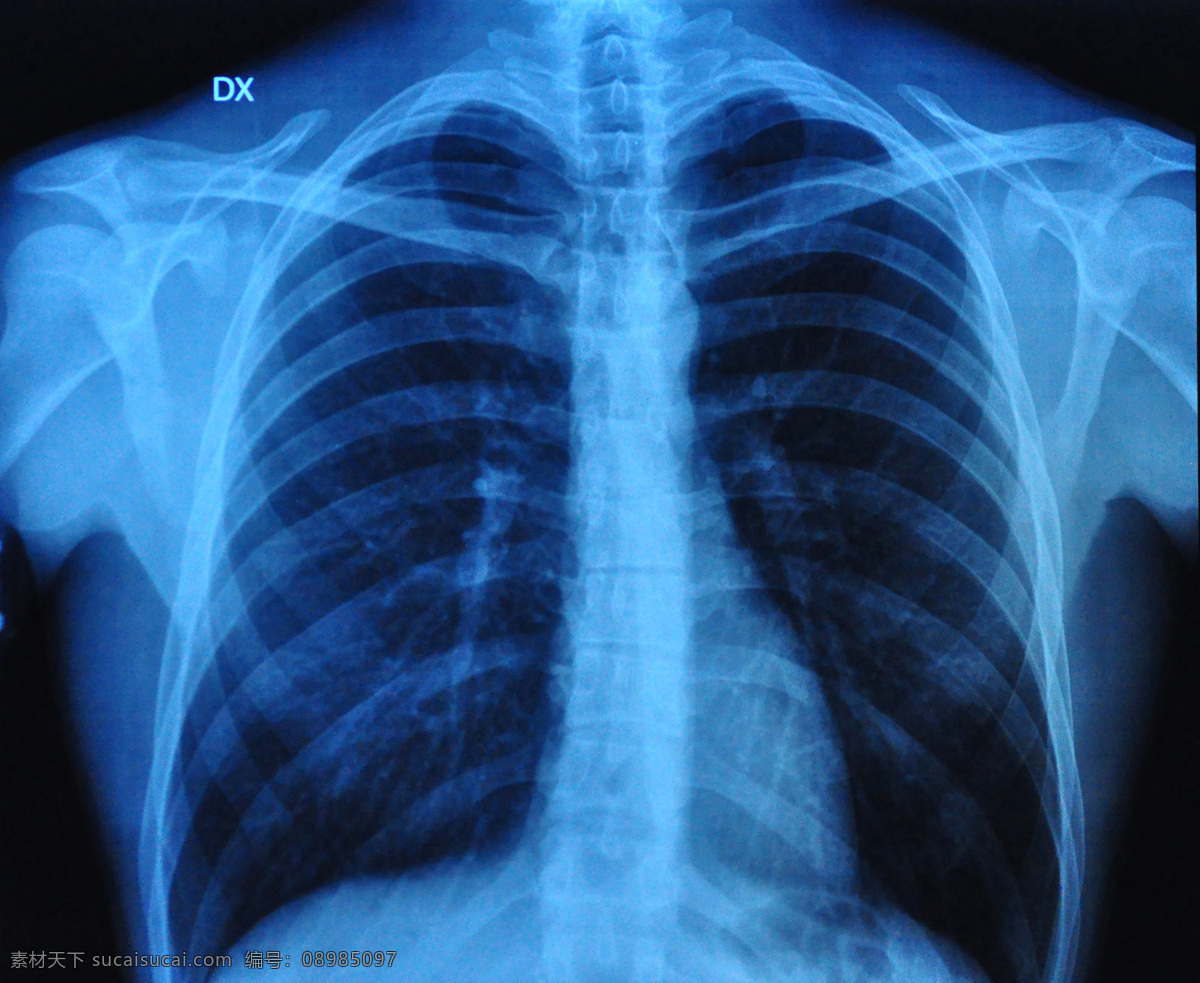 胸部x光 胸部 胸腔 x光 透视图 骨骼 胸肺 疾病 治疗 医院 检查 诊治 医生 现代科技 医疗护理
