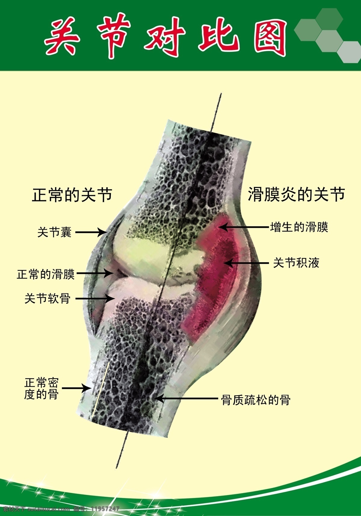 关节对比图 关节 对比图 滑膜炎 骨质对比 膝关节 分层