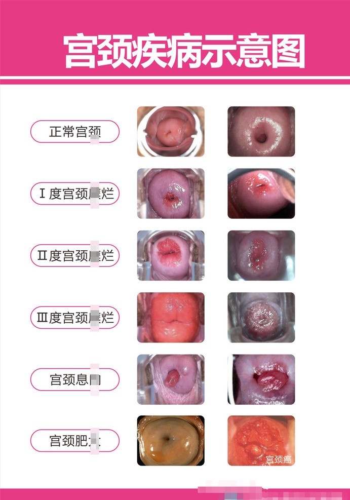 宫颈 疾病 示意图 宫颈图 宫颈病变 宫颈病变图 矢量 宫颈糜烂图 宫颈糜烂 正常宫颈 宫颈息肉 宫颈肥大 妇科 妇科挂图 医疗 广告 解剖 图 科室