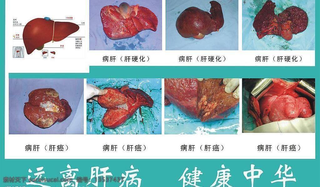 乙肝 危害 三 步 曲 生活百科 矢量图库 室内 宣传设计 医疗保健 海报 护外招贴 其他海报设计