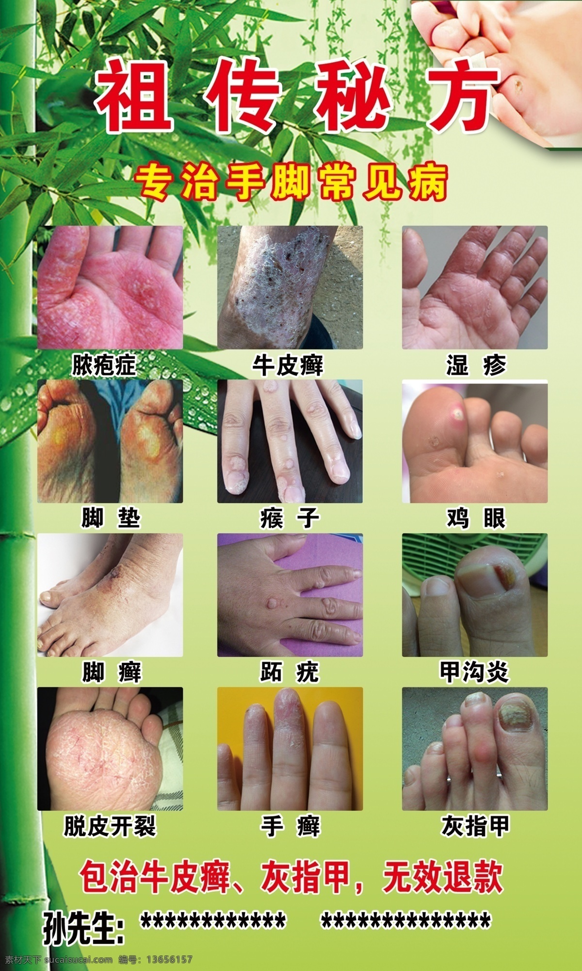 祖传秘方 牛皮癣 灰指甲 鸡眼 湿疹 瘊子 脚癣 甲沟炎 手癣 脱皮开裂 脚垫 脓包症