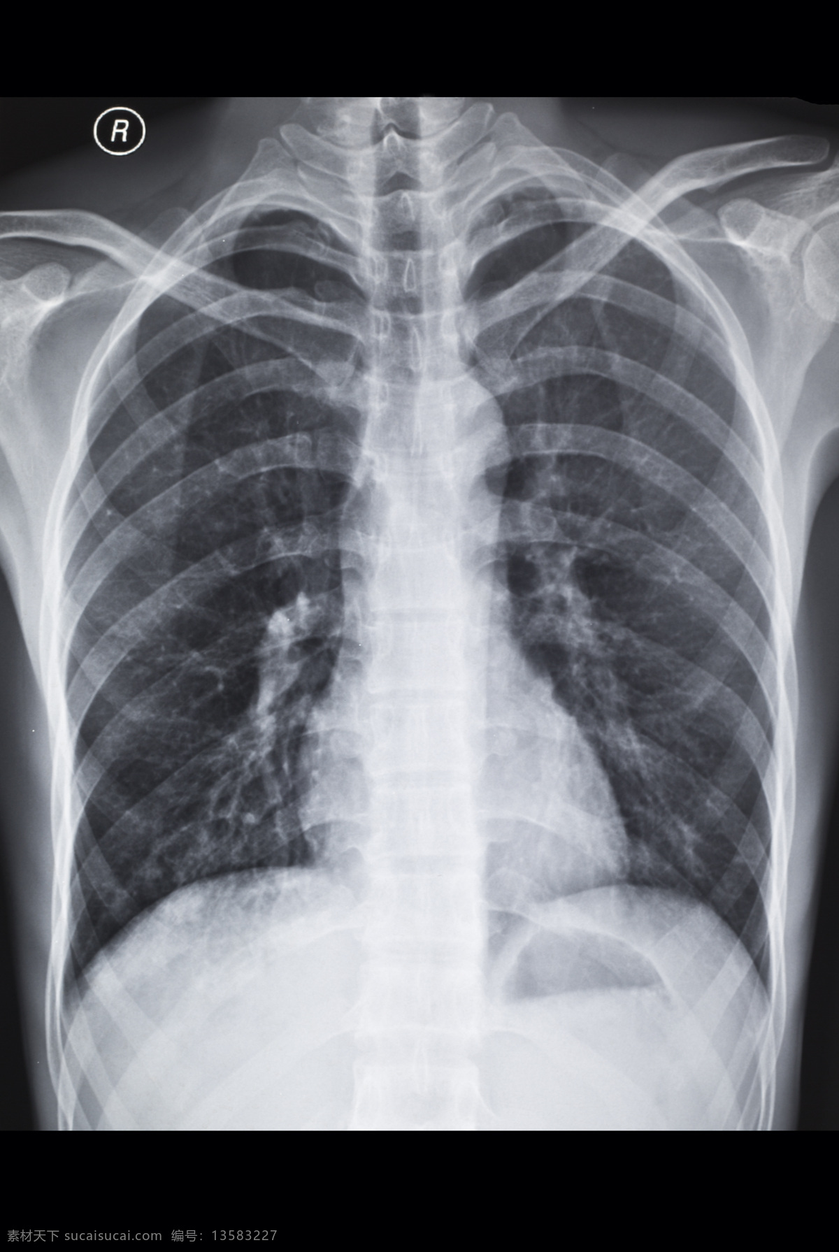 胸腔x光片 胸腔 胸部 x光 透视 医疗 ct x光片 核磁共振 医疗护理 现代科技